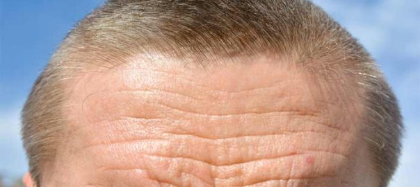 What Causes Deep Forehead Wrinkles