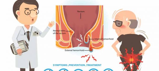 Home Remedies to Treat the Hemorrhoids
