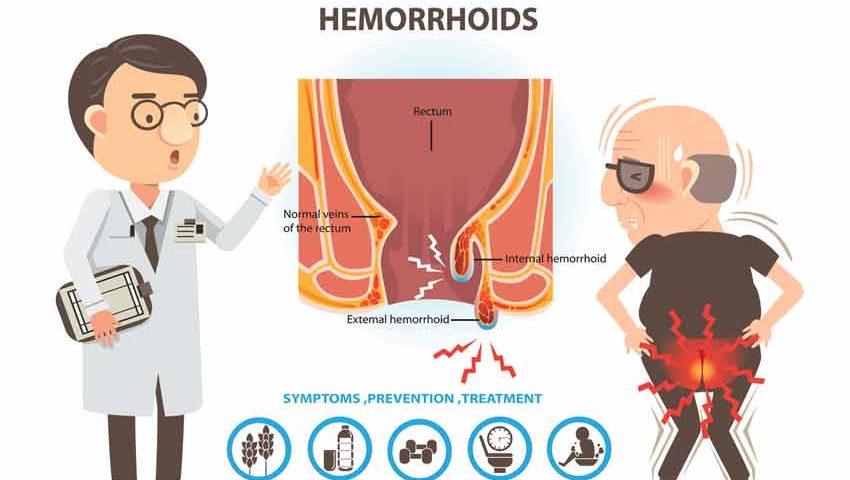 Home Remedies to Treat the Hemorrhoids