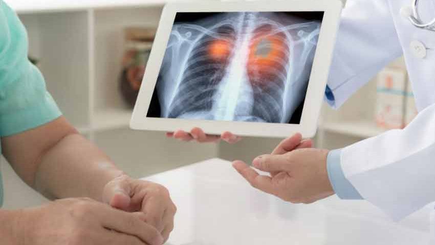 What are the Natural Cures for Lung Cancer