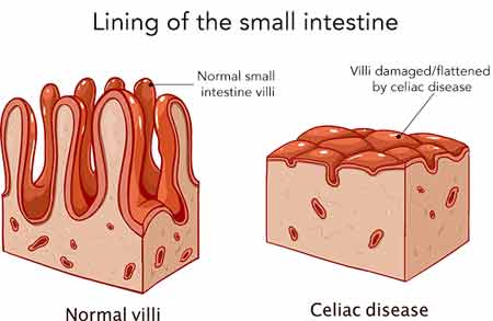 Celiac Disease