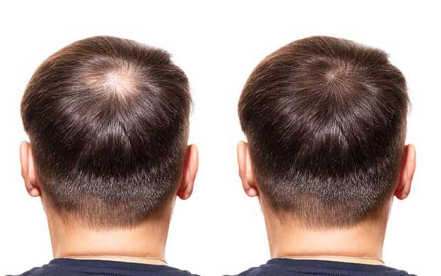 What are the causes of hair loss