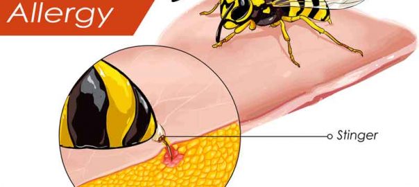 How to Relieve Pain of Bee Sting