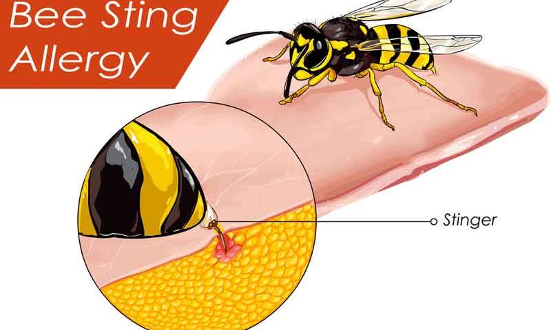 How to Relieve Pain of Bee Sting