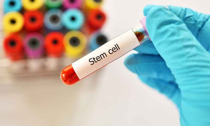 Stem Cell Transplant May Provide Cure for AIDS