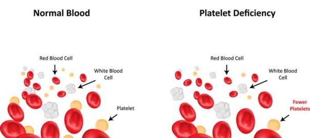 Thrombocytopenia