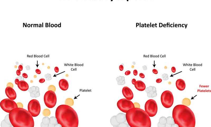 Thrombocytopenia